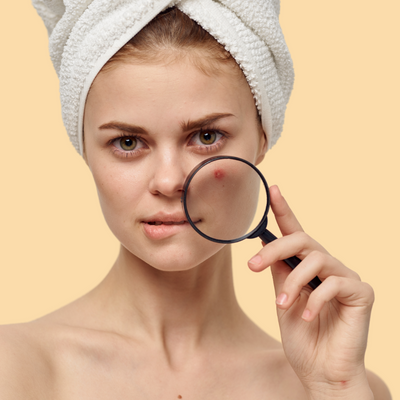 Acné & Imperfections